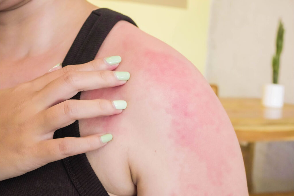 Бывает ли аллергия на солнце?